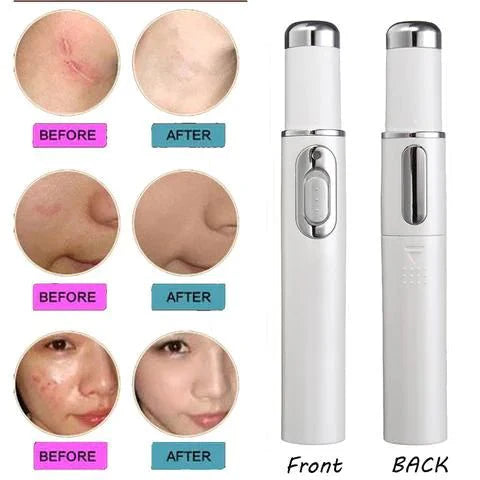 Blue Light Therapy Acne Laser Pen - Scar & Blemish Reduction