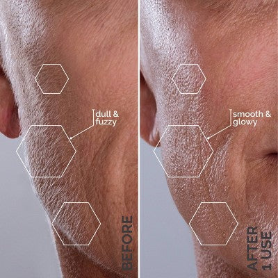 Herramienta de dermaplaning sónico SIMA Deluxe de Spa Sciences para exfoliación y eliminación de vello facial - Imperfect Box