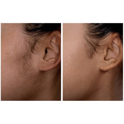 Herramienta de dermaplaning sónico SIMA Deluxe de Spa Sciences para exfoliación y eliminación de vello facial - Imperfect Box
