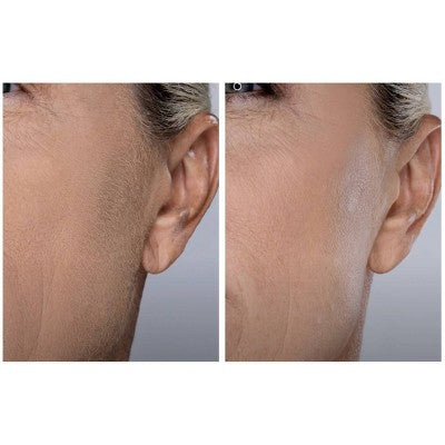 Herramienta de dermaplaning sónico SIMA Deluxe de Spa Sciences para exfoliación y eliminación de vello facial - Imperfect Box